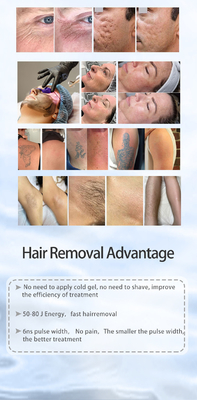 Tudo em um de Picosecond Laser depilação e ND YAG Laser de remoção de tatuagens máquina