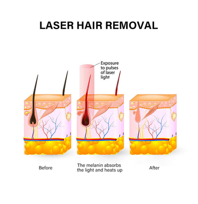 Dispositivo portátil de depilação a laser 810nm Máquina de depilação permanente para mulher