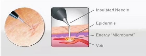 Salão de beleza Máquina de laser de diodo 980nm para alívio da dor / tratamento vascular