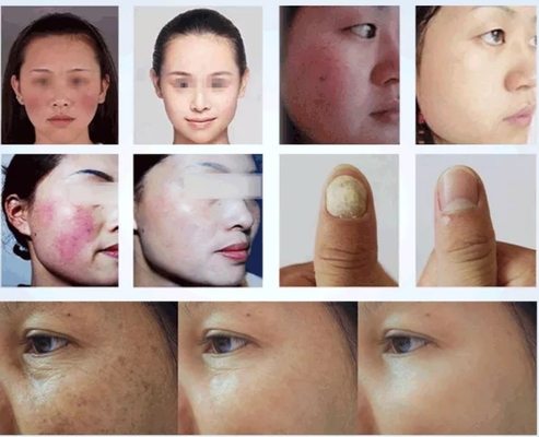 Salão de beleza Máquina de laser de diodo 980nm para alívio da dor / tratamento vascular