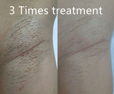 Dispositivo de depilação a laser de diodo multifuncional, suportando diferentes larguras de pulso para redução permanente de pelos personalizada