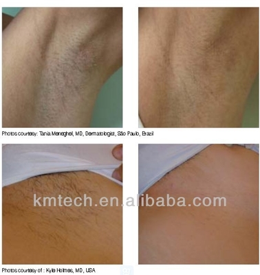 Máquina de depilação a laser de clínica profissional Diodo 3 ondas KM960D