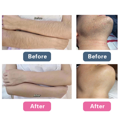 Máquina de rejuvenescimento facial a laser de picossegundos, Máquina de remoção de tatuagens com Q.