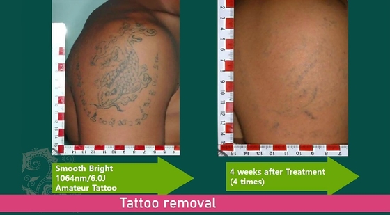 Máquina de rejuvenescimento facial a laser de picossegundos, Máquina de remoção de tatuagens com Q.