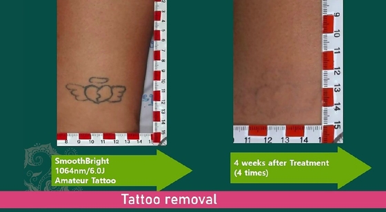 Máquina de remoção de tatuagens a laser com Q 1064nm 532nm 755nm