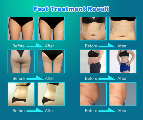 Máquina de remoção de rugas, Máquina de massagem para reduzir gordura.