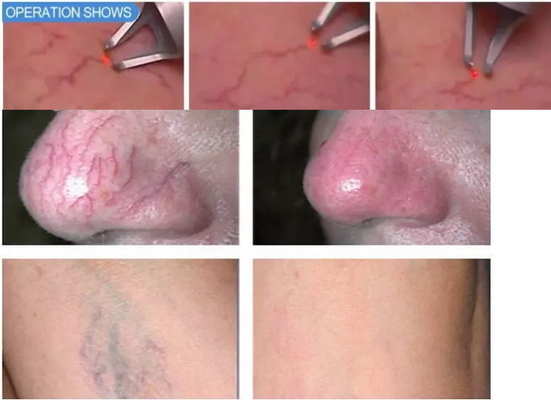 Rejuvenescimento da pele Máquina de laser de diodo de 980nm Máquina de remoção de veias de aranha portátil