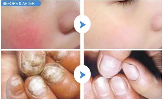 Máquina de remoção vascular a laser de 15W 30W para tratamento de unhas dos pés / rejuvenescimento da pele a laser quente