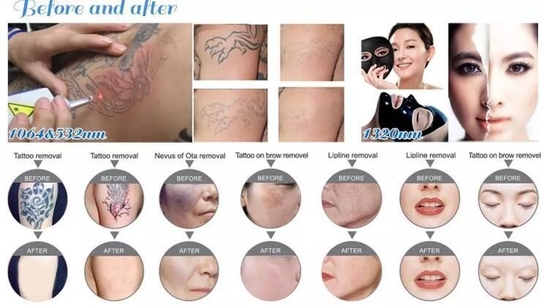 Máquina de remoção de tatuagens por laser Nd YAG portátil 1064nm 532nm 1320nm comprimento de onda