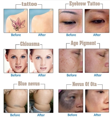 Q Switch Nd YAG Máquina de remoção de tatuagens a laser 1064nm 532nm 1320nm 2 anos de garantia