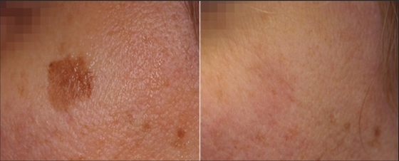 3 em 1 Q Switch ND Yag Laser Machine Remoção de tatuagens Serviços OEM ODM