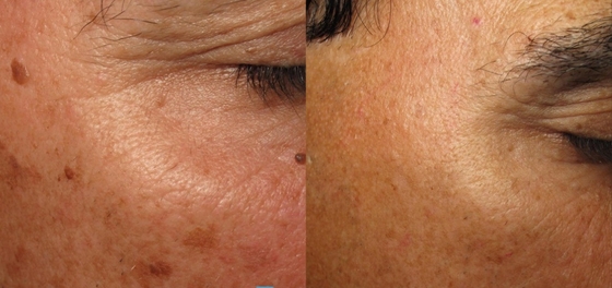 3 em 1 Q Switch ND Yag Laser Machine Remoção de tatuagens Serviços OEM ODM