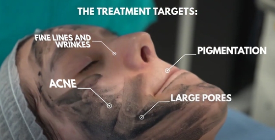 3 em 1 Q Switch ND Yag Laser Machine Remoção de tatuagens Serviços OEM ODM