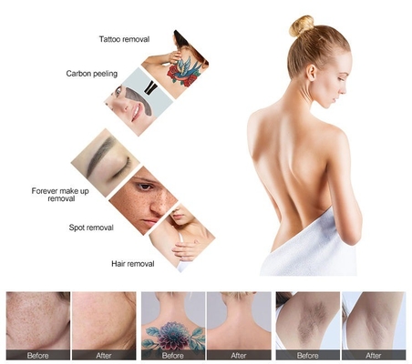 Máquina médica de remoção de cabelo Nd YAG 1064nm 532nm Equipamento de remoção de tatuagens a laser