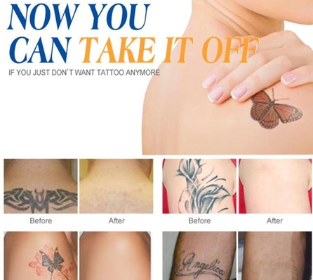 Máquina de Laser Q Switch ND Yag personalizada para remoção de tatuagens / tratamento de acne