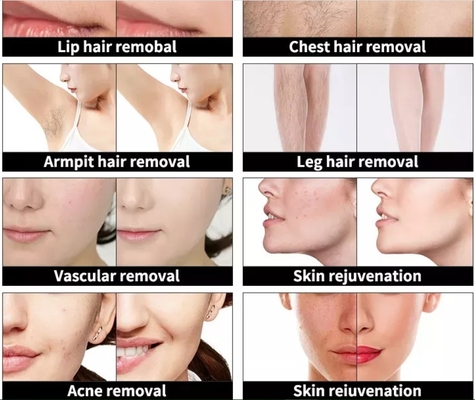 4 em 1 Máquina de beleza multifuncional Máquina de remoção de tatuagens a laser de 3 ondas