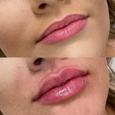 4 em 1 Máquina de beleza multifuncional Máquina de remoção de tatuagens a laser de 3 ondas