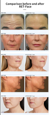 Ems faciais magnéticos verticais Rf Rejuvenescimento da pele Elevação da pele Apagamento da pele Emagrecimento Rf Elevação Máquina machifor sal