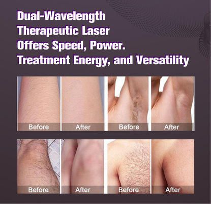 Large spot size candle laser alexandrite depilação cabelos brancos REMOVAL 2000w alexandrite dispositivo a laser