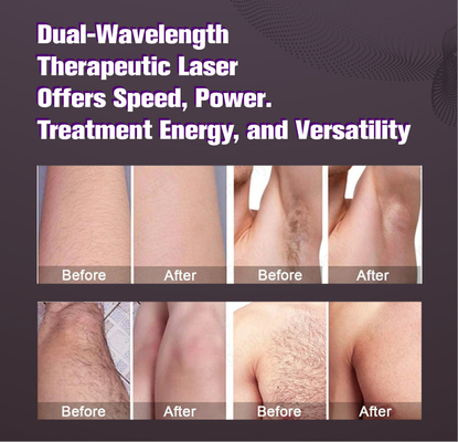 Máquina de laser de alexandrite profissional 755nm Serviços OEM ODM
