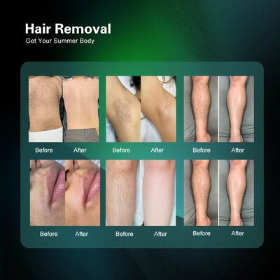 755nm Alex Laser 1064nm Long Pulse Nd Yag Hair Removal Alexandrite Laser Candle Machine Manufacturer Price